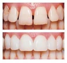 Crowns and Veneers at Warnbro Sound Dental